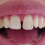 Diastemas - Dentes Separados