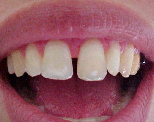 Diastemas – Dentes Separados