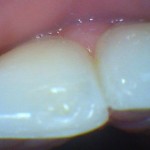 lesao_dente_piercing_de_lingua_6
