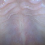 lesao_palato_piercing_de_lingua_7