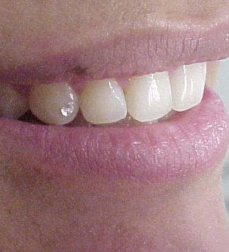 Piercing dental