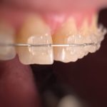 Aparelho transparente