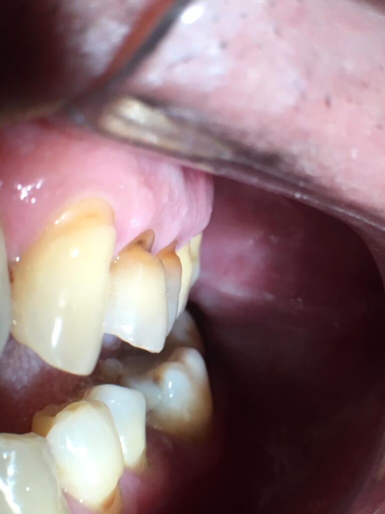 abfração / lesão cervical