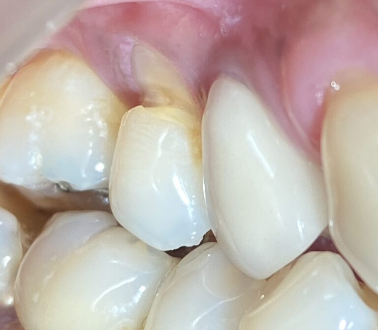 Você  tem sensibilidade no pé do dente ou sentiu um “buraco” ? Entenda o que pode ser e quando procurar um dentista